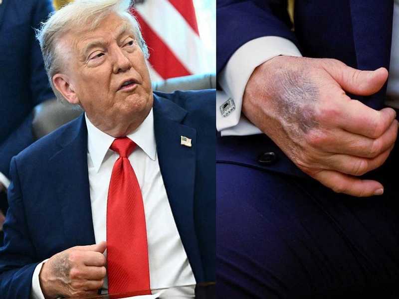 كدمات على العمل التجريبي حيث تكهنات واسعة النطاق للجميع
