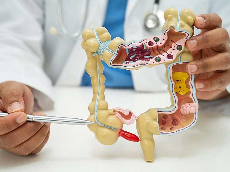 دراسه حديثه: استئصال الزائده الدوديه الملتهبه قد يقلل خطر الاصابه بسرطان القولون