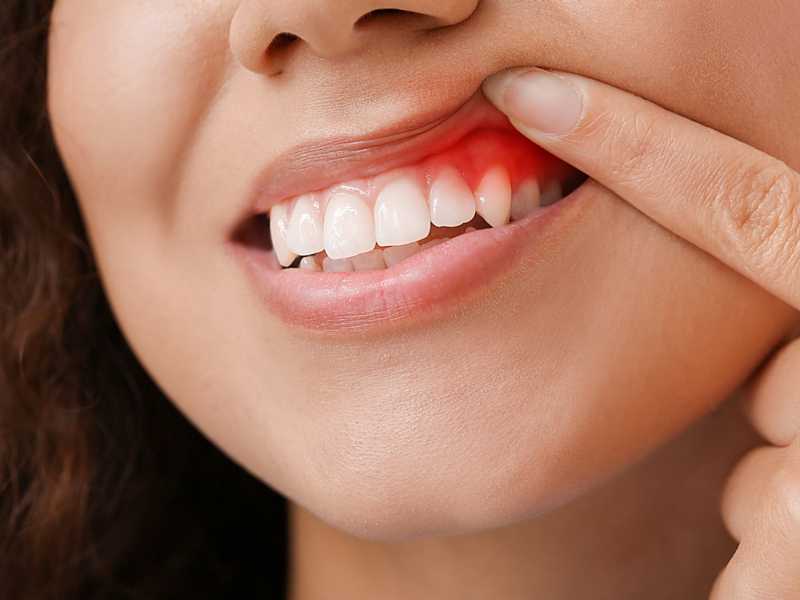 دراسه حديثه تحذر من اهمال امراض اللثه